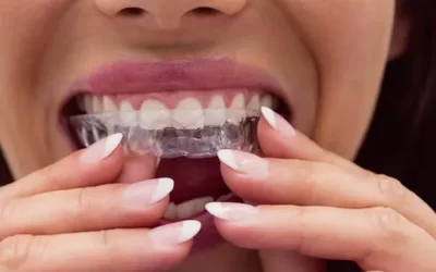 Invisalign Tallahassee: Clear Aligner Therapy for Discreet Orthodontic Correction